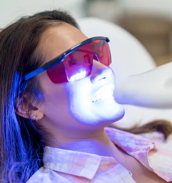 In-office laser whitening